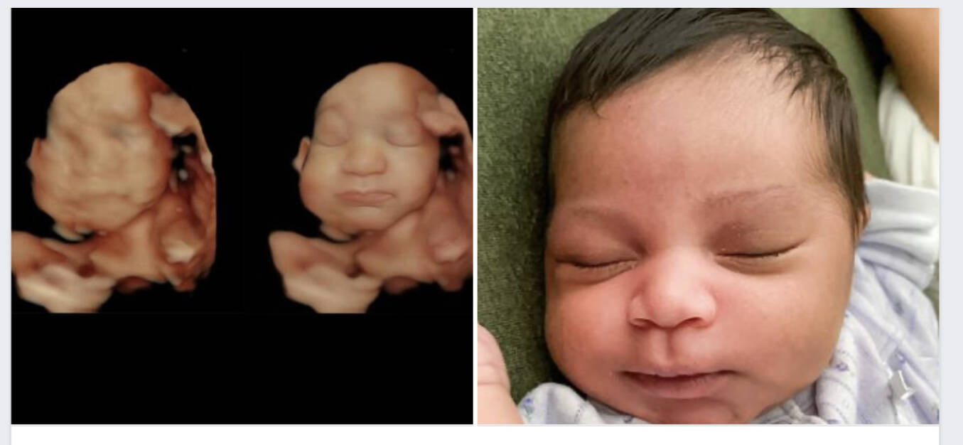 The ultrasound scan on the left was enhanced, resulting in a more detailed image (in the middle). The fetus shows a strong resemblance with its newborn sibling (on the right). (Photo provided)