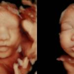A 5D ultrasound scan of a fetus, before and after enhancement. (Photo provided)